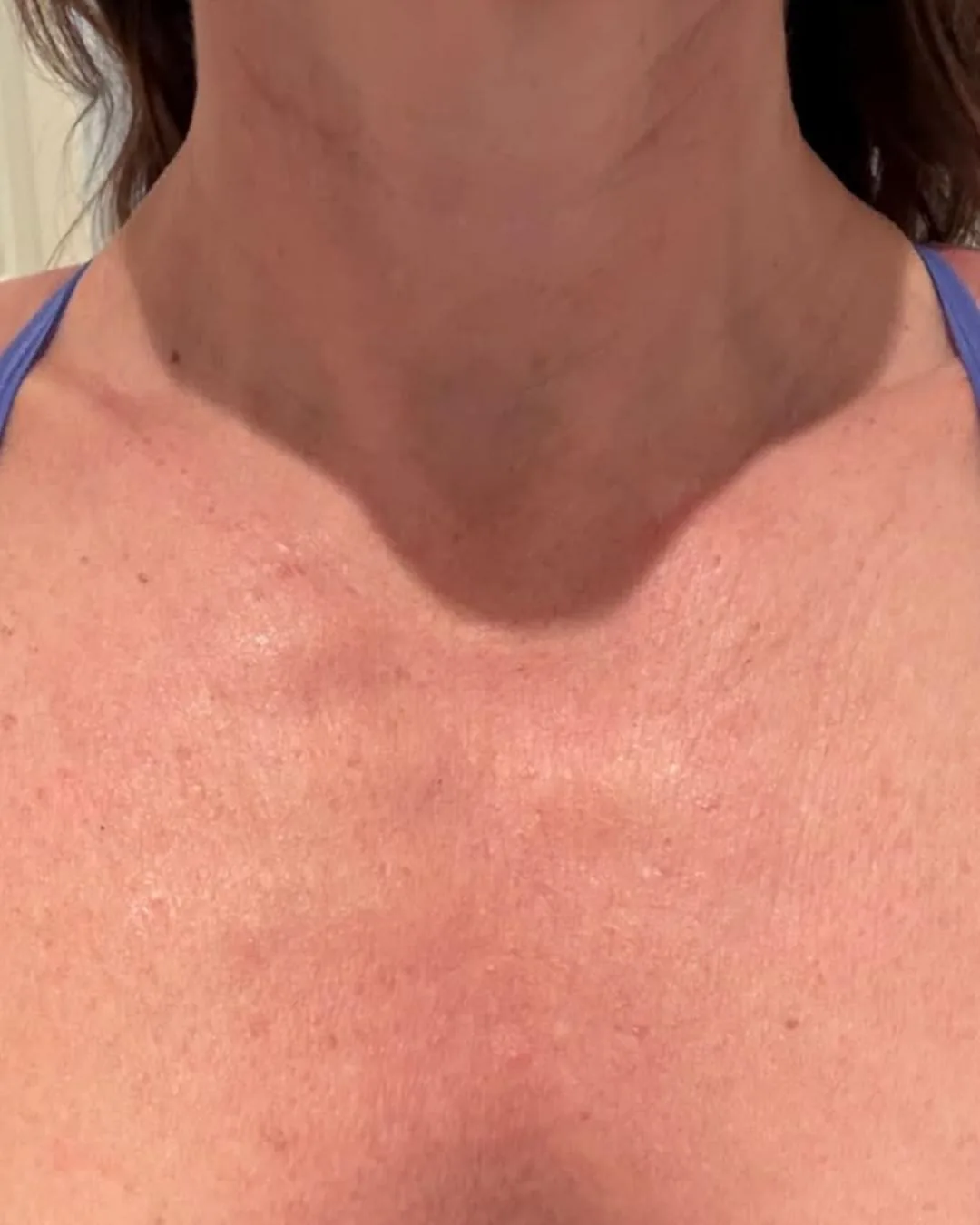 Décolletage skin after the treatment journey