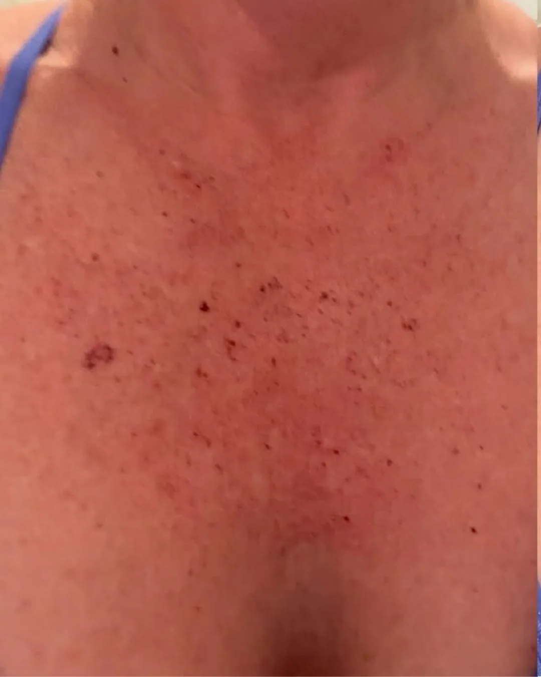 Visible skin response after treatment of pigmentation
