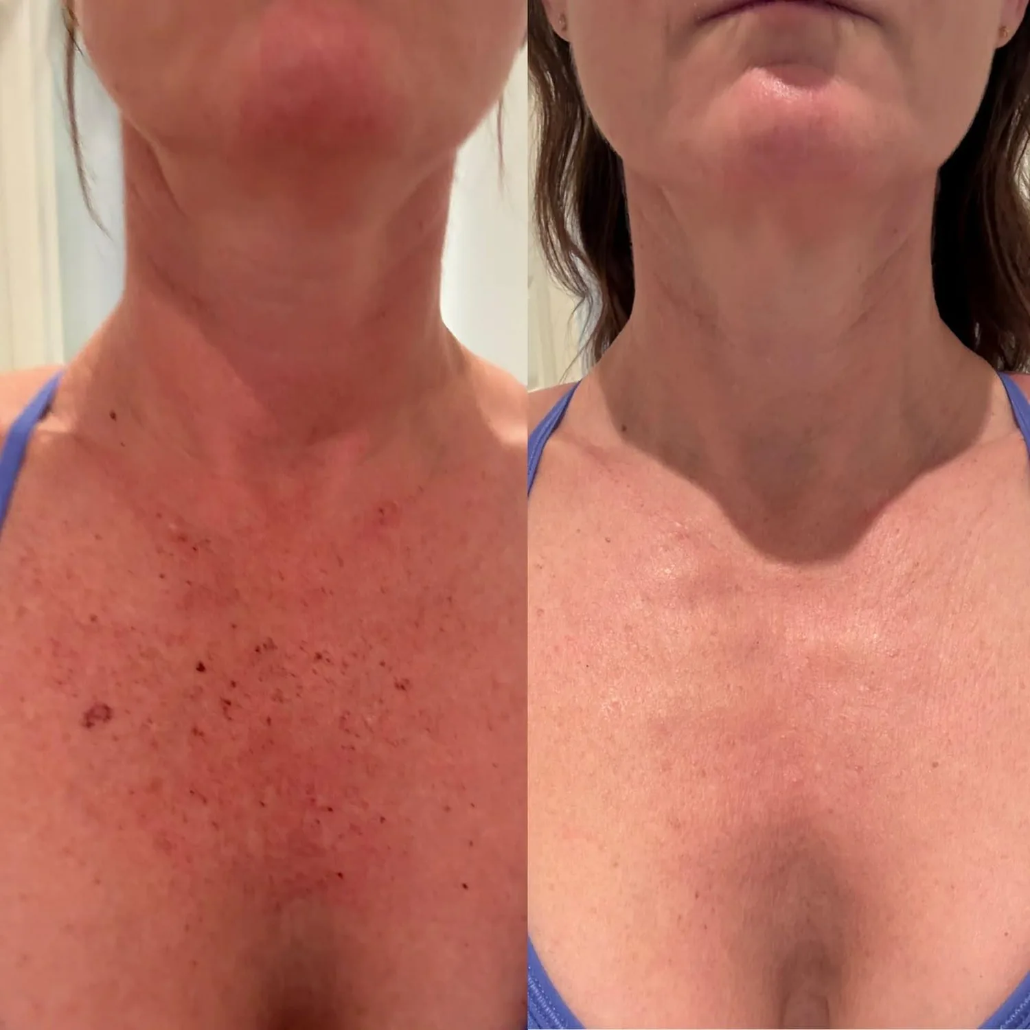 Décolletage skin appearance before and after treatment