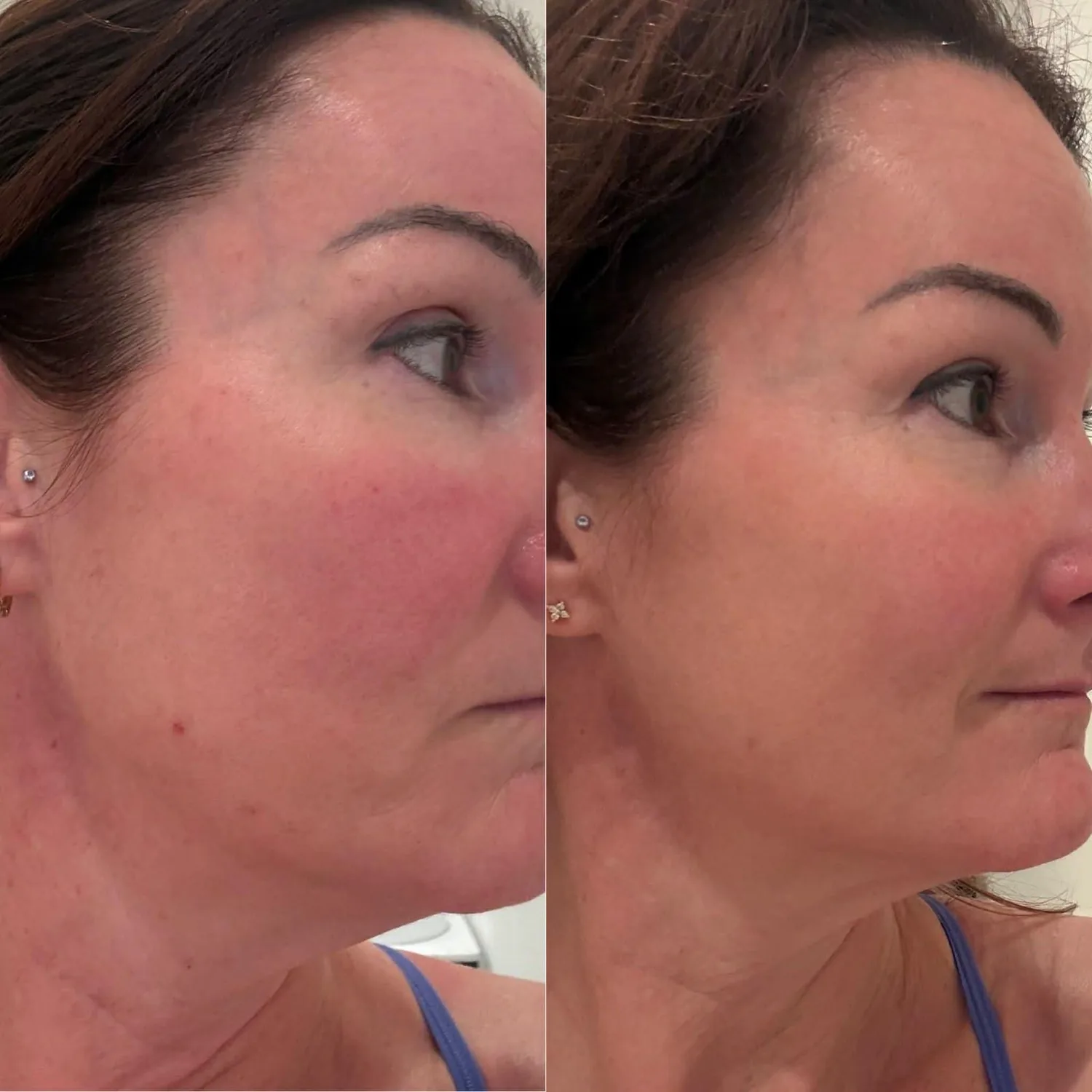 Before and after corrective BBL treatment for facial redness and uneven tone, including treatment of a discrete red spot near the jawline